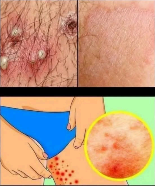 Herpes Zoster Uncovered: Causes, Warning Signs, and the Best Ways to Fight Back